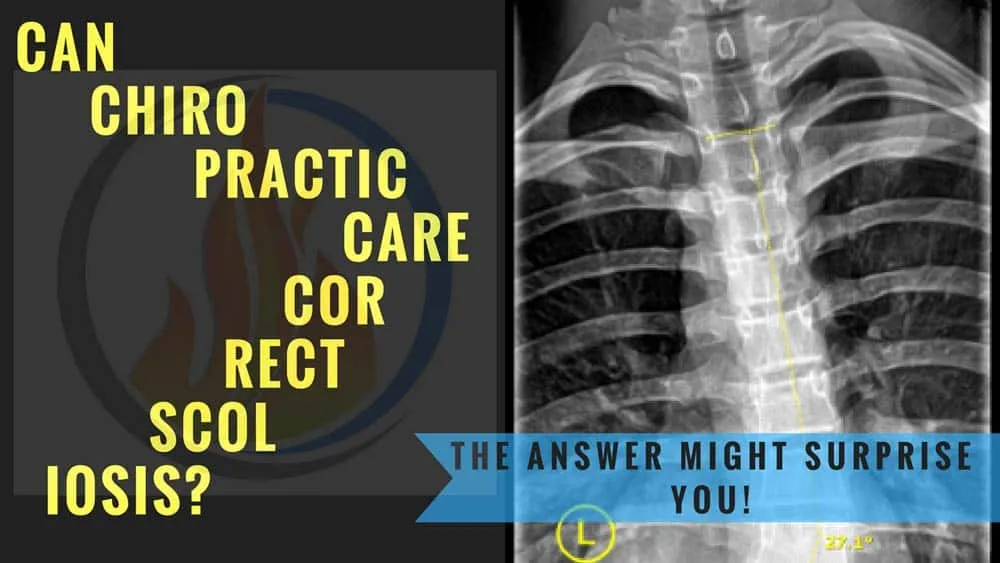 Can Chiropractic Care Correct Scoliosis?