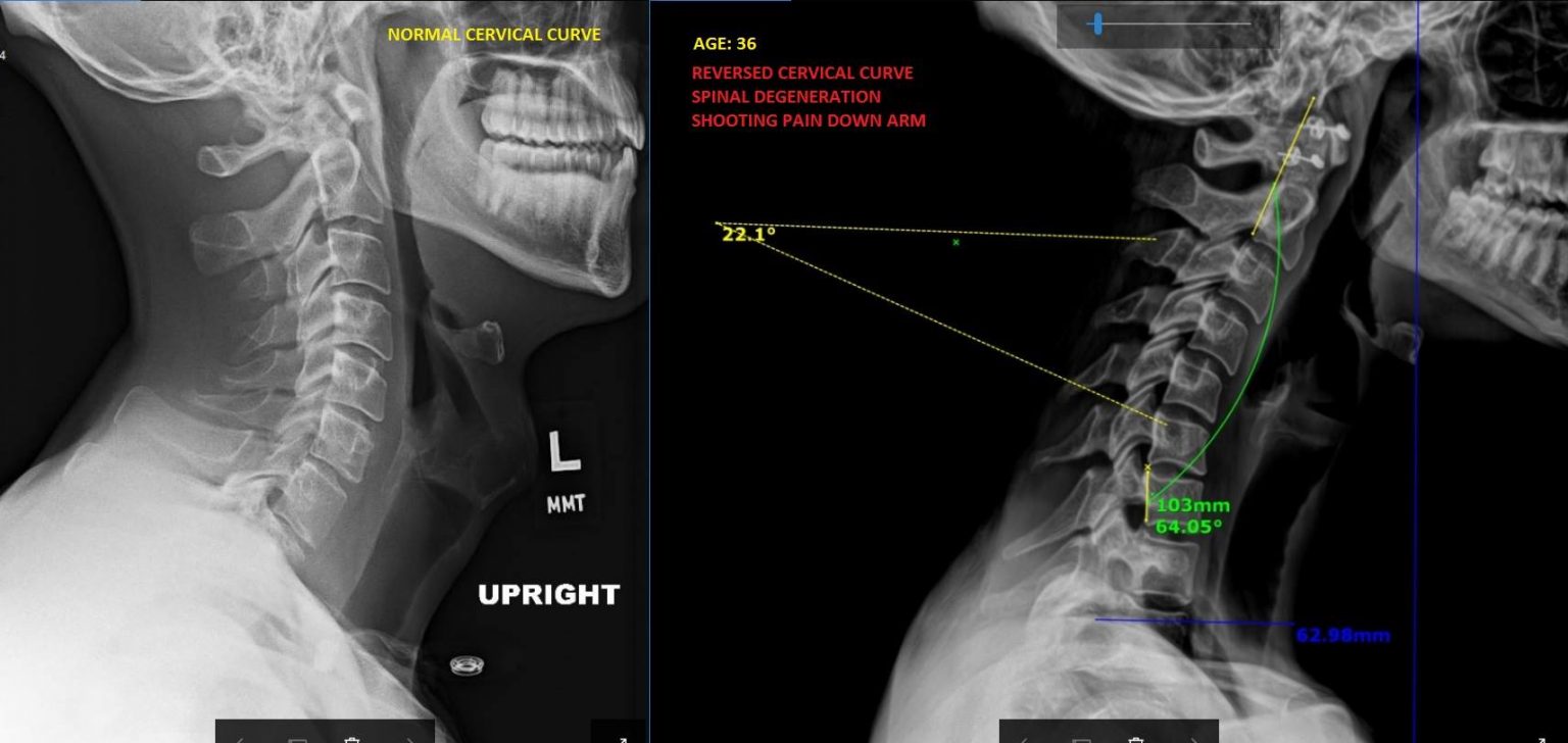 correct-your-posture-thrive-spine-center